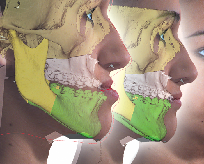 Planificación 3D de cirugía ortognática: comparación del perfil facial antes y después